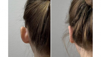 Otoplastie – operație estetică la urechi